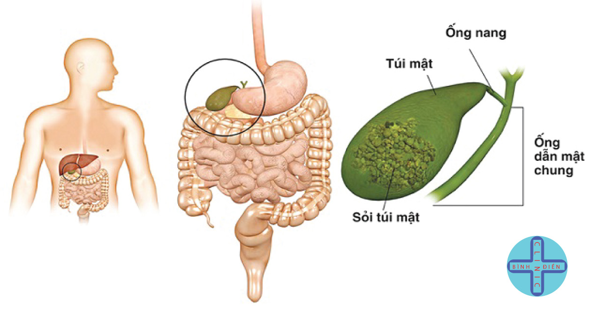 Cách điều trị sỏi mật