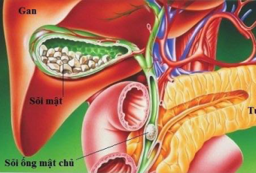 Chẩn đoán sỏi mật