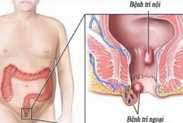 Trĩ và các bệnh hậu môn