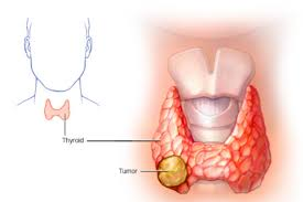 Chẩn đoán và điều trị UNG THƯ TUYẾN GIÁP