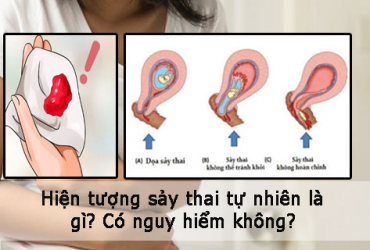 SẨY THAI LIÊN TIẾP